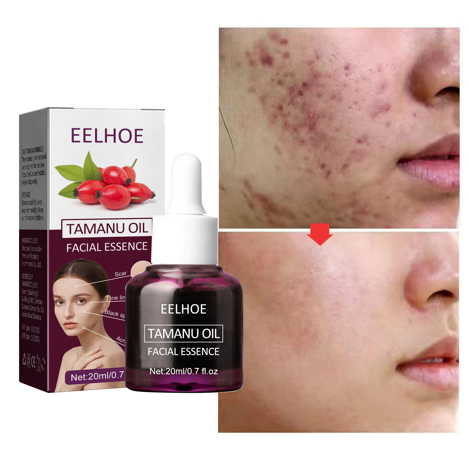 

Herbal Acne Removal Serum Repair Spots Effective Acne Blackheads Treatment Control Shrink Pore Skin Care Moisturizing Oil