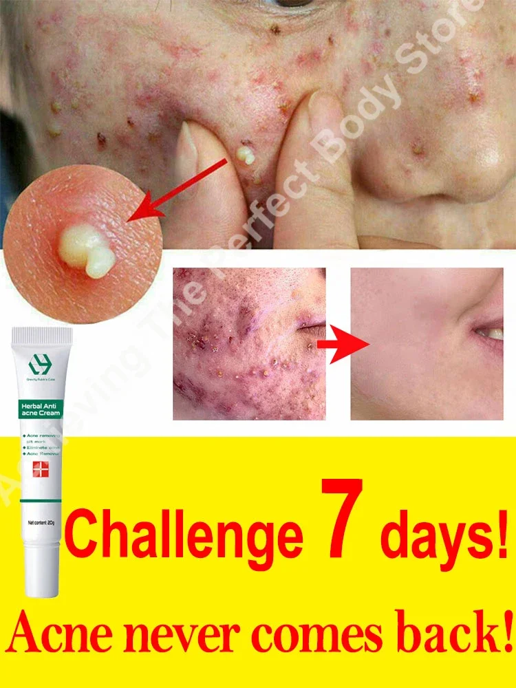 Acne treatment face cream anti scars for pimples removal