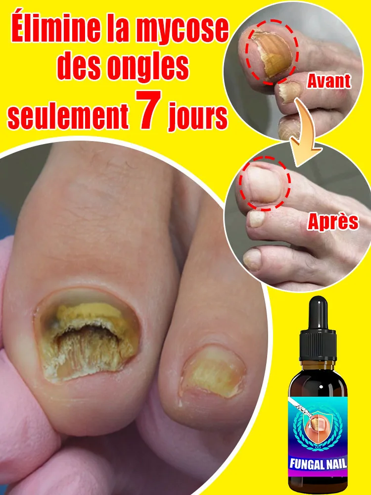Fungal Nail Treatment Serum Foot Nail Fungus Removal Repair Gel Anti Infection Paronychia Onychomycosis Foot Nails Care Essence