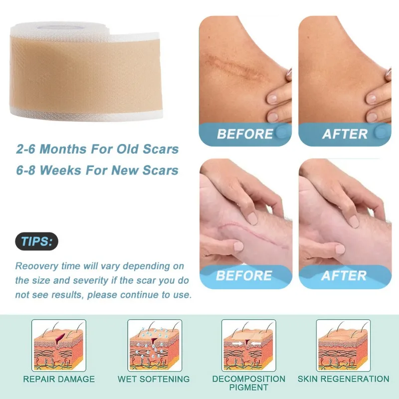 Silicone Scars Sheets Keloid Bump Removal Strips Scars Reducing Treatments Surgical Scars Burn Tummy Tucks Acne C-Section 1 Roll