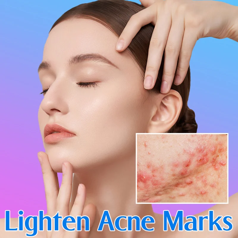 

Salicylic Acid Acne Gel Acne Acne Marks Shrink Pores Oil Control Anti-inflammatory Effectively Repair Skin Moisturize Smooth