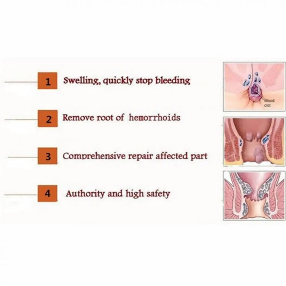 20g Pain Relief Hemorrhoid Ointment Internal And External Mixed Hemorrhoid Plant Formula Herbal Relieve Itching