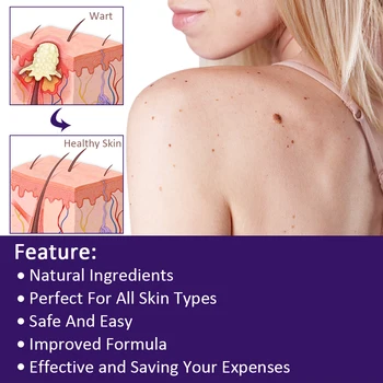 Removing Against Moles Remover Anti Verruca Remedy Liquid Pen Treatment Papillomas Removal Of Warts Liquid From Skin Tags 5