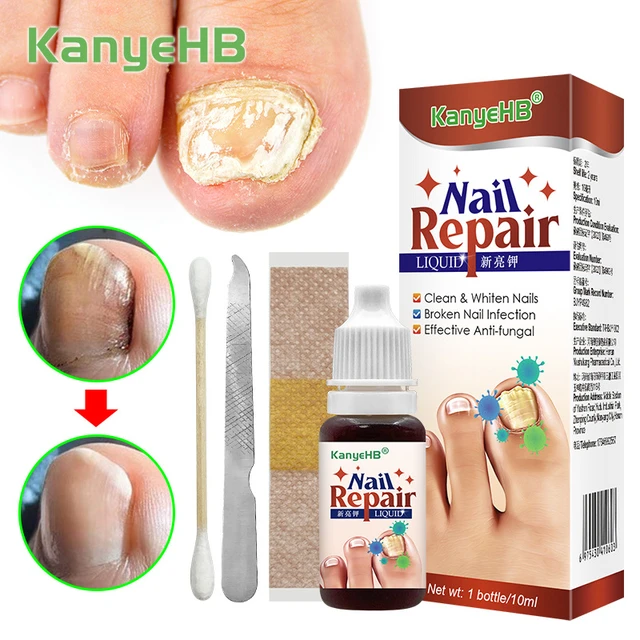 Nail Care Solution Repair Nails Inhibition of Fungal Infections Toenail  Fungus Treatment Product - Walmart.com