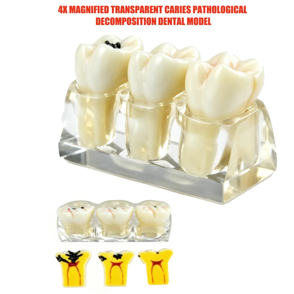 Model zęba z próchnicą, czterostopniowa dekompresja próchnicy, badanie patologiczne, model demonstracyjny progresji próchnicy do nauki dla dentystów.
