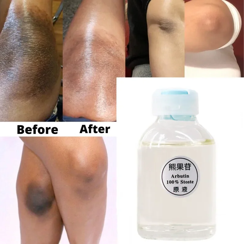 아르부틴 피부 브라이트닝 에센스 리퀴드, 크로아스마 제거, 브라이트닝 세럼, 코직산 표백 크림, 드롭쉽 