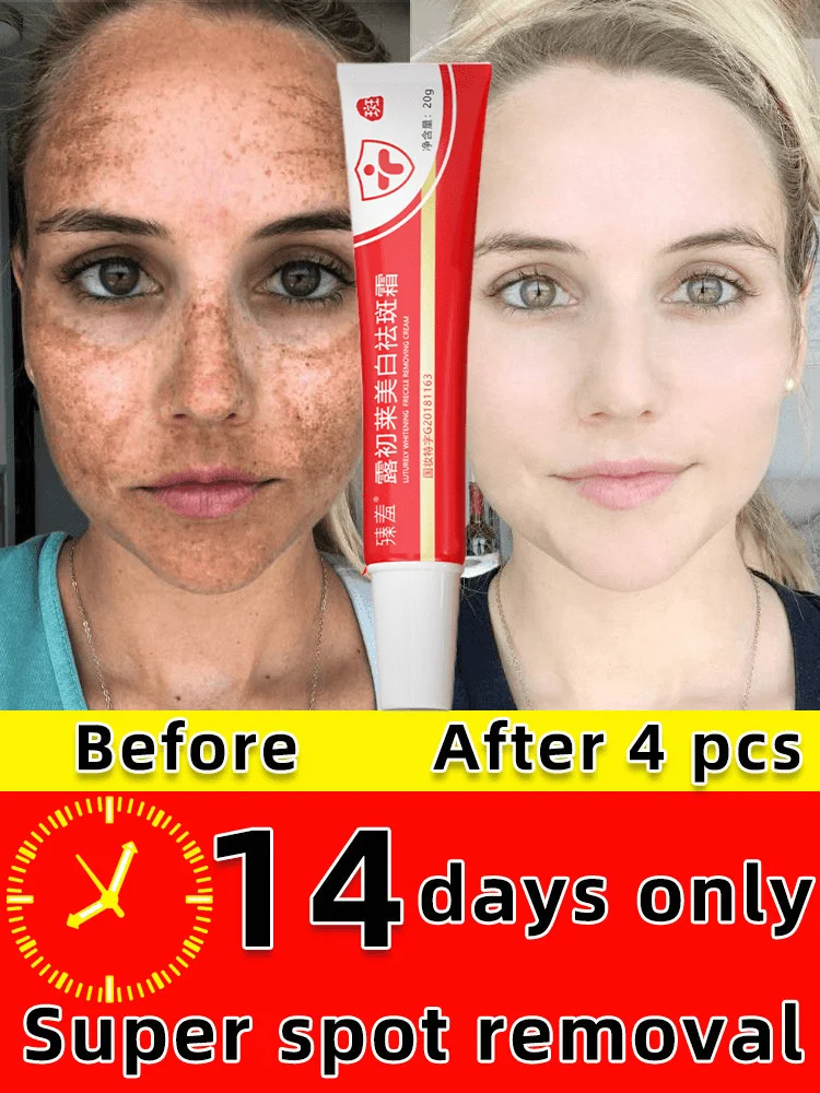 Freckle Whitening Cream Black Dots Melasma Remover Anti Brown Stain