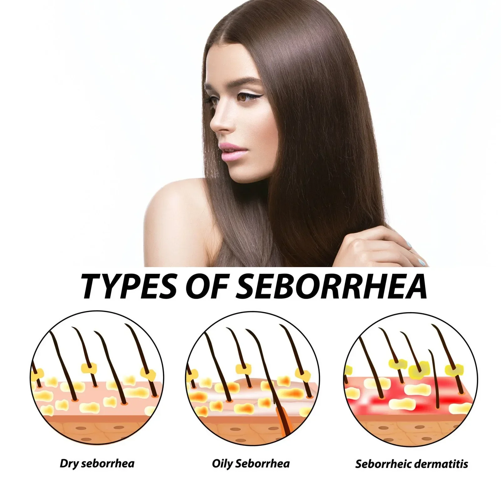 Psoriasis Treatment Serum for Scalp Head Acne Scalp Ringworm Treatments Repair Moss Reduce Dandruff Head Skin Care Roller