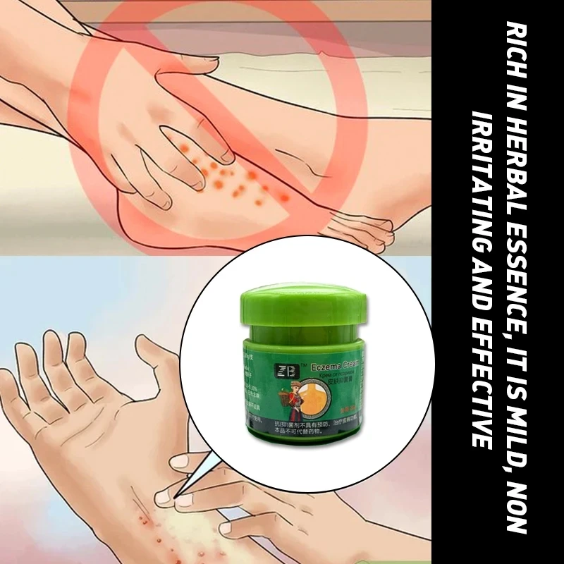 20 г ZB Трав’яний крем проти свербіння Полегшення поту Герпес Мазь Псоріаз Екзема Видалення дрібних блістерів Руки Ноги Суха шкіра Догляд Свербій