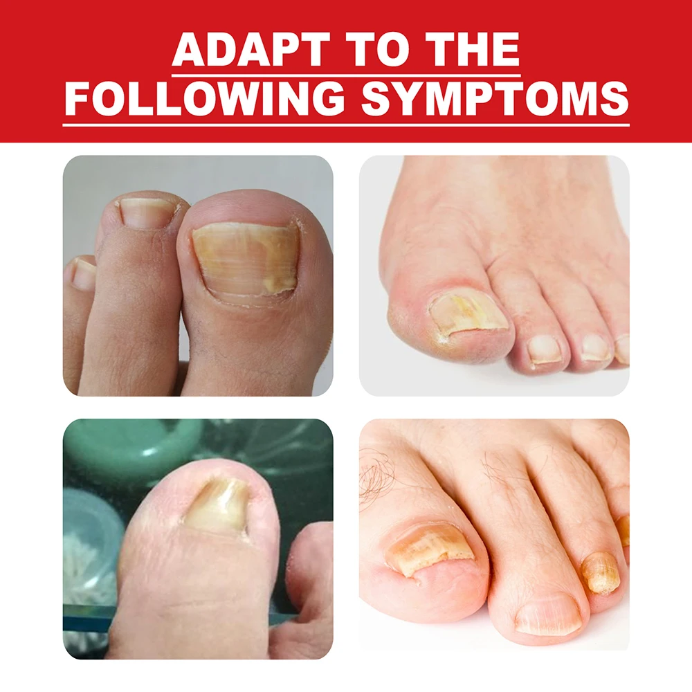 Nail Fungal Infection Treatment in Chandigarh | Dr Aditi Jha