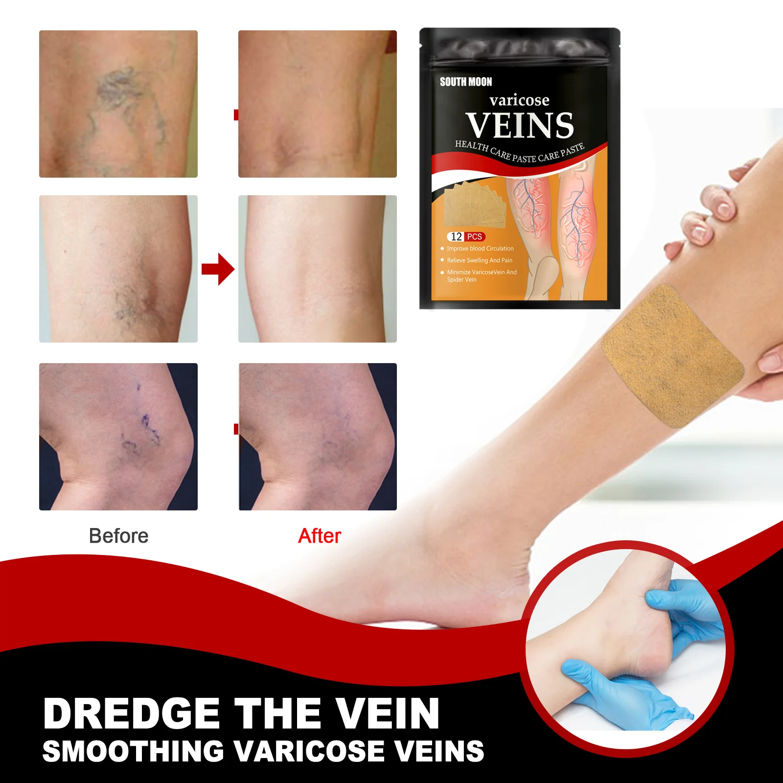 Varicose Vein Massage Treatment Spray Relief Vasculitis Phlebitis