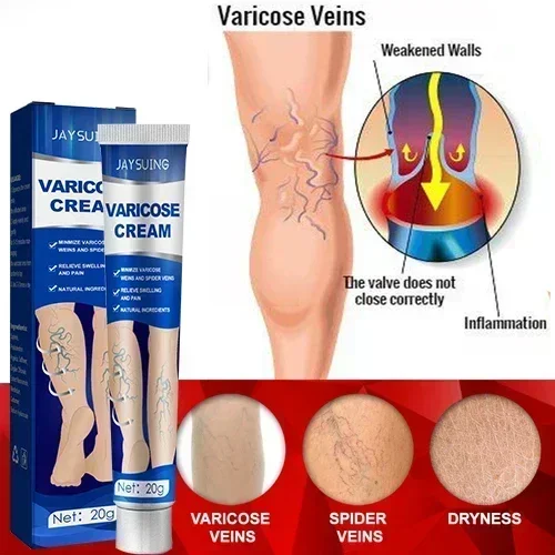 Effective Relief Varicose Vein Ointment Relieve Varicose Vein Vasculitis Spider Legs Pain Treatment Care Essential Cream varicose vein ointment