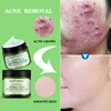 JoyPertty À Base de Plantes Crème De Traitement De L'acné Boutons Enlèvement De Cicatrice Crème Pour Le Visage Huile Contrôle Rétrécir Les Pores Soins De La Peau Beauté Santé