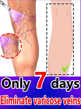 varicose vein cream, vasculitis treatment, 1
