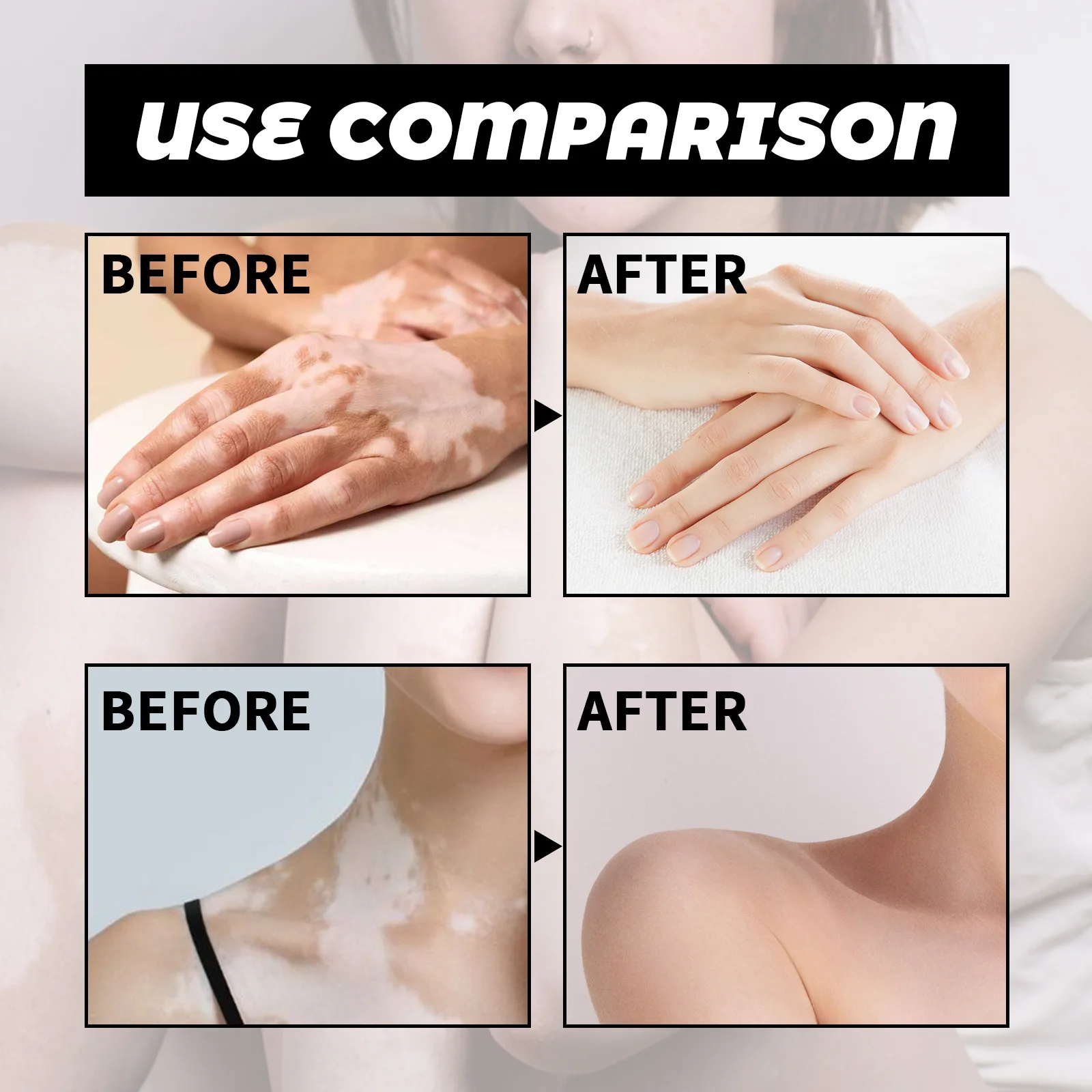 Spray traitement vitiligo élimination taches blanches soin peau_voghion.com