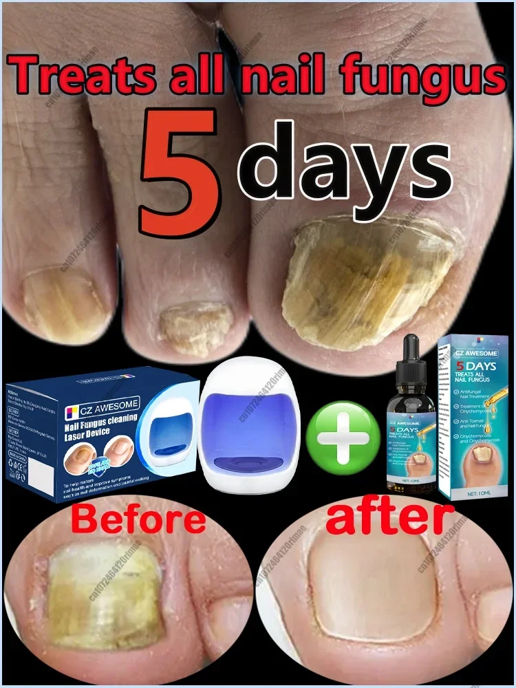 Fungal Nail Laser Device Repair Fast Nails Fungus Onychomycosis