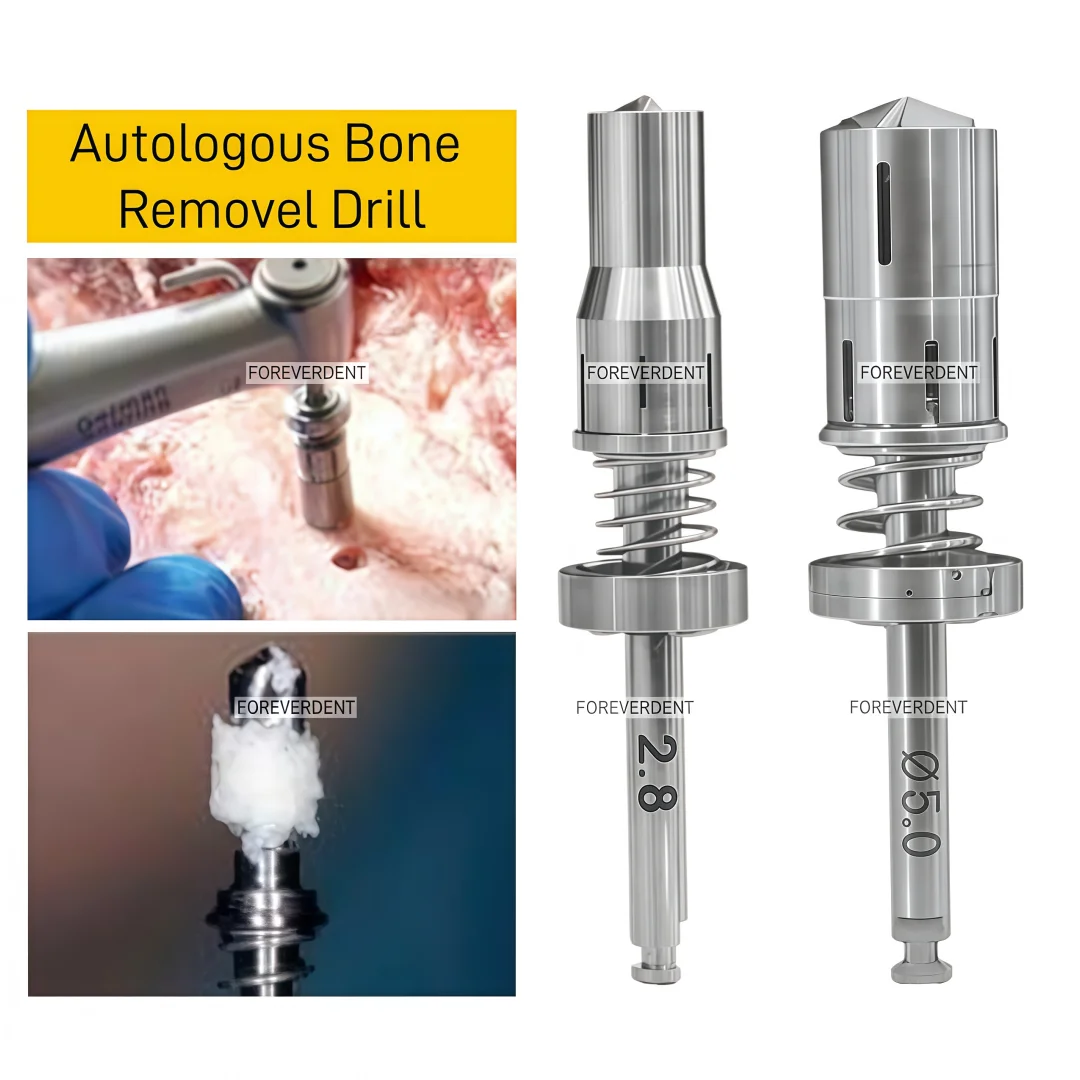 Dental Bonesier Autogene Knochenentnahme-Bohrer Federknochenentnahme-Bohrer Selbstschleifender Knochenpulver-Sammelbohrer
