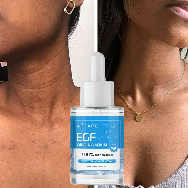 Pattanás Kezelés A Szérum 100% Egf Tiszta Természetes Esszencia Hatékonysága Súlyos Pattanások Eltávolító Pattogó Javítás Bőrfehérítés - Image 4