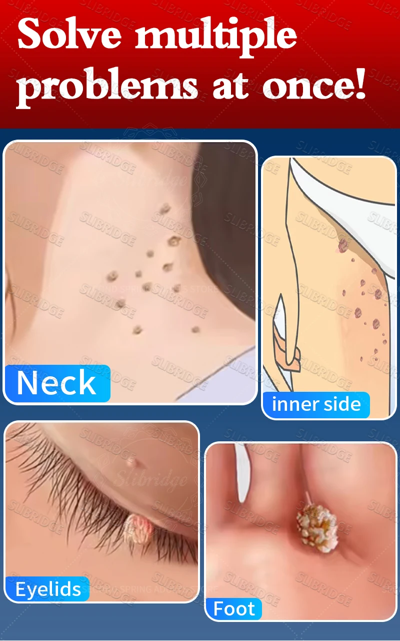 Flacone blu sicuro ed efficace per rimuovere le verruche, strumenti per il corpo, congelamento delle verruche._voghion.com