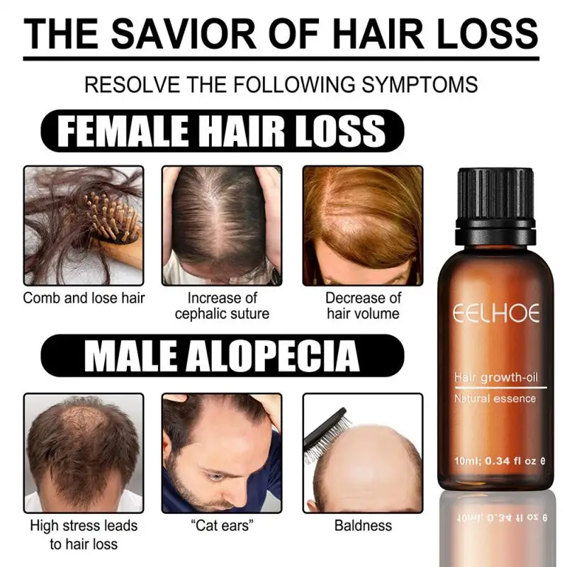 Eelhoe Rosemary Hair Growth Essential Oil Anti Hair Loss Fast Regrowth  Serum Scalp Treatments Damaged Thinning Repair Hair Care - Hair Loss  Product Series - AliExpress