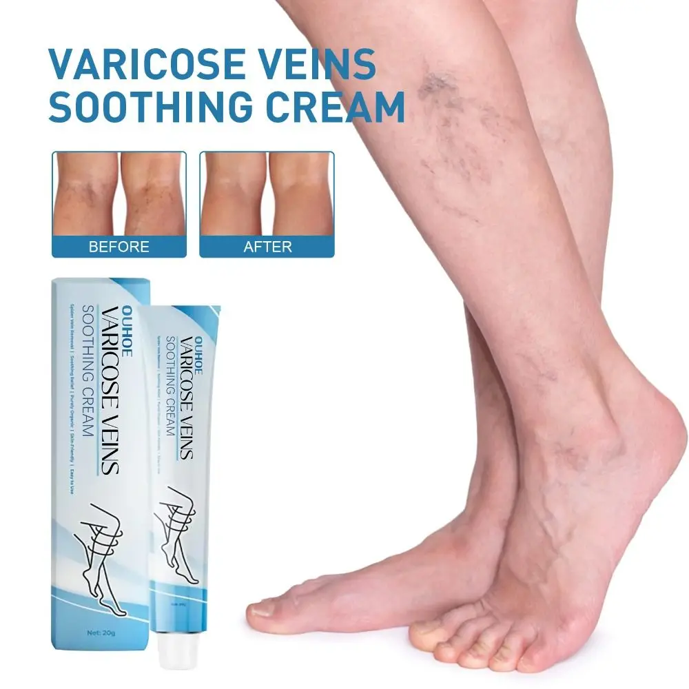 

2PCS Soothes Tired Varicose Veins Treatment Cream Improve Blood Circulation Fast-Acting Wellness Cream Reduce Leg Swelling