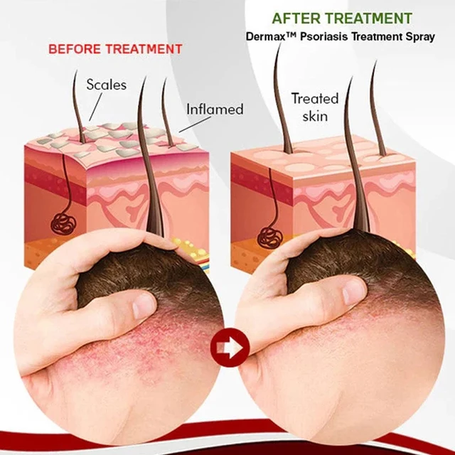 Psoriasis Antibakteriális Krém Dermatitis Ekzematoid Hatékony - Image 4