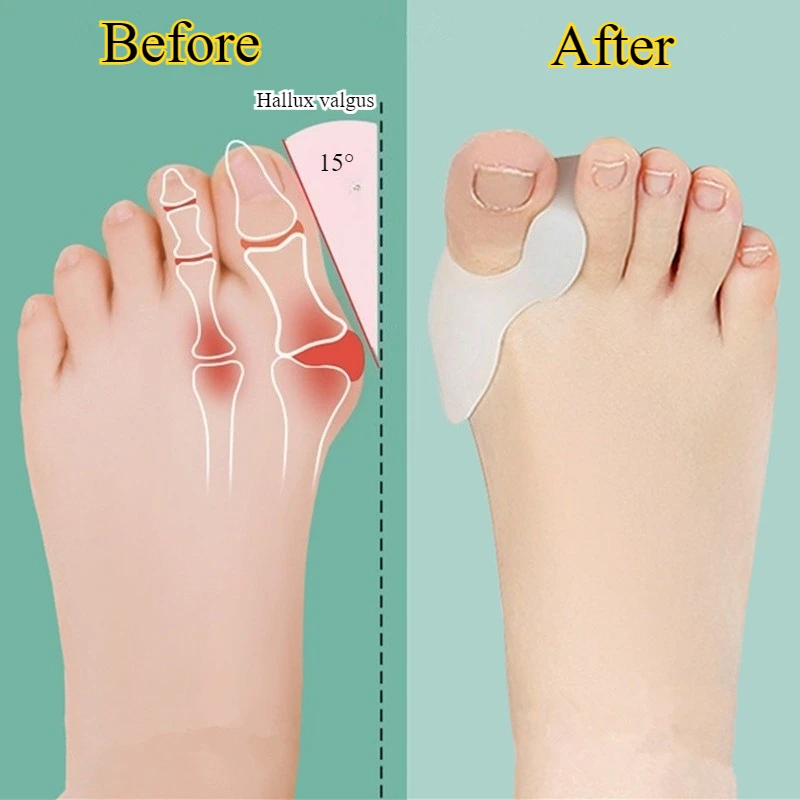 Bunion Corrector Big Toe Splint With Gel Pad For Pain Relief_voghion.com