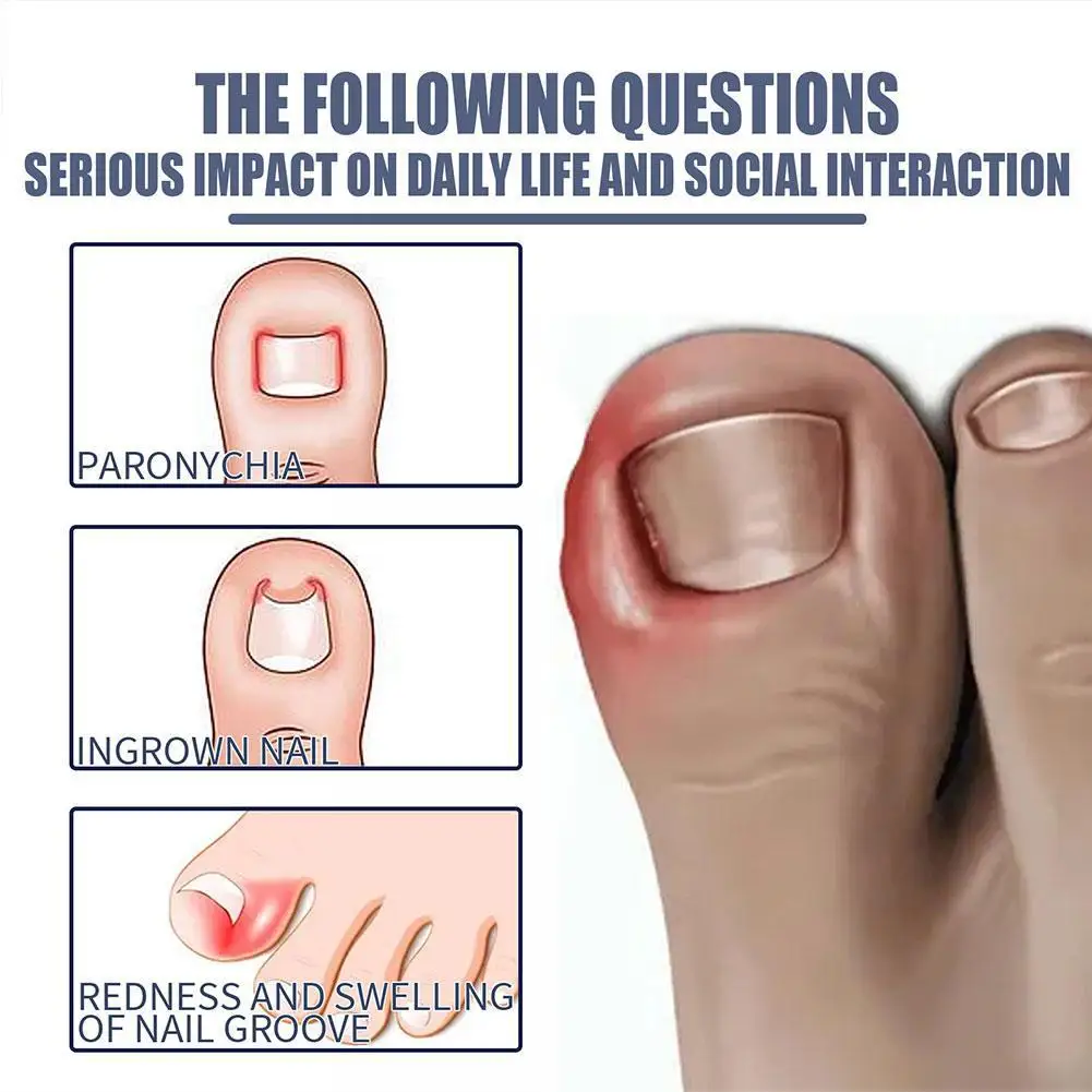 Endogenous Nail Repair Care Essential Oil Essence Clean and Remove Toenail Treatment Feet Care Removal Paronychia Oil