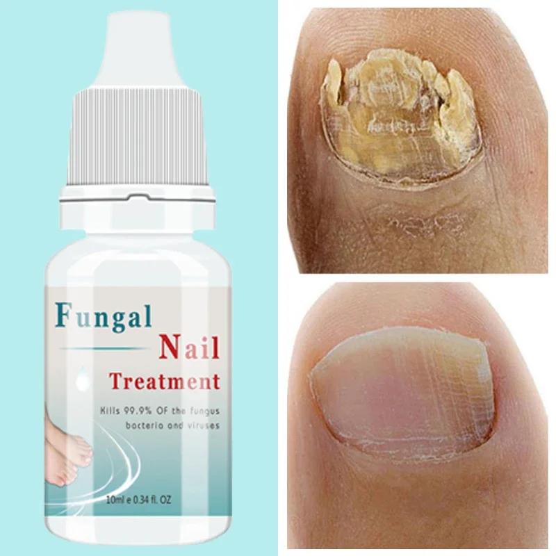 

Nail Fungus Treatment Serum Foot Repair Liquid Toe Nails Fungal Removal Gel Anti Infection Paronychia Onychomycosis Cream 10ml