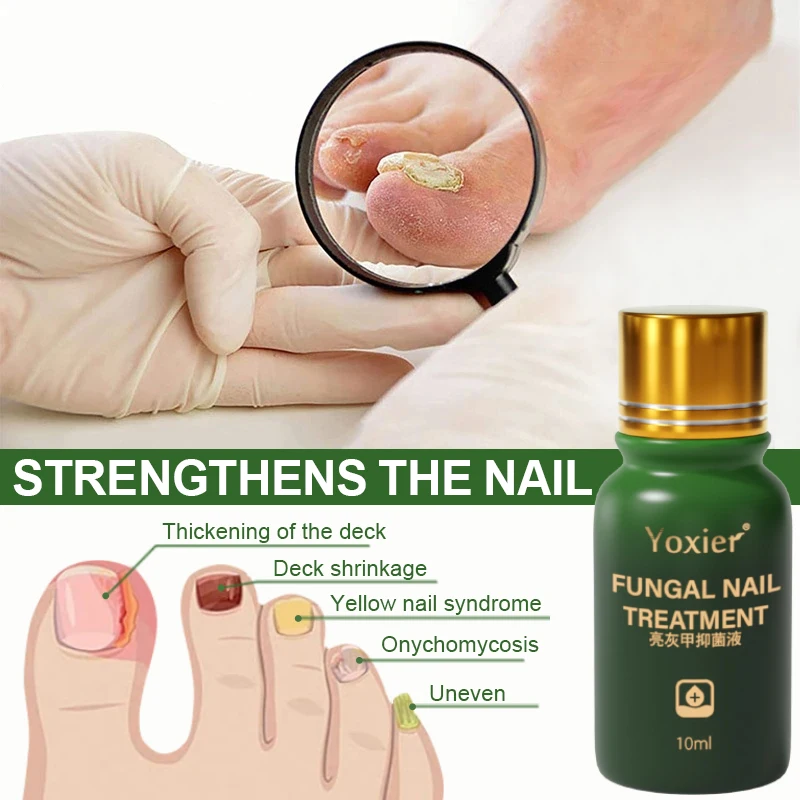

Nail Fungus Therapy Serum Nail Health Care Solution Repair Renew Damaged Onychomycosis Relieve Nail Loss Regeneration 10ml
