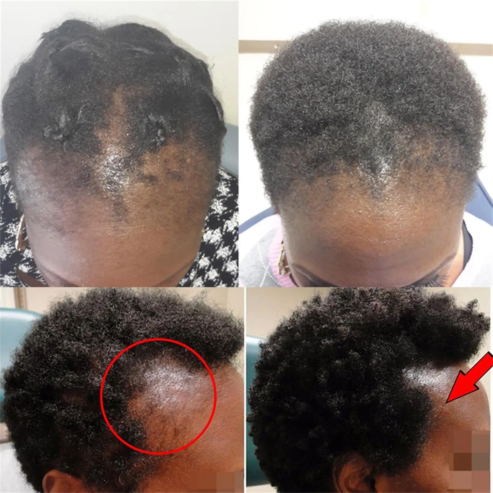 Description Picture 2 of itemPowerful Hair Growth Serum Spray Ginger Anti Hair Loss Treatment Products Repair Nourish Hair Roots Fast Regrowth Hair Men Women