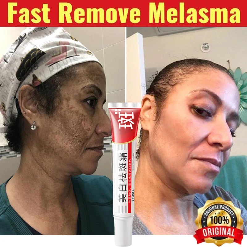 Whitening Freckle Cream Melasma Dark Spots Pigmentation Removal Products Fade Stain Melanin Repair Brighten Korean Skin Care