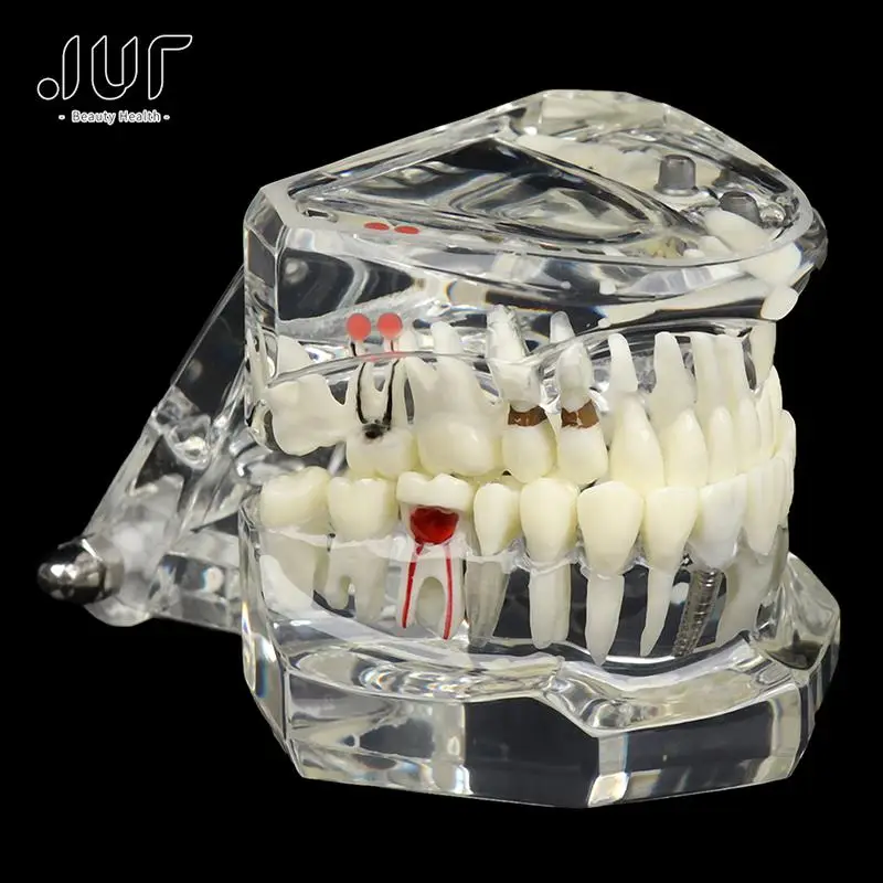 Hot Sale Dental Implant Disease Teeth Model for Medical Teaching Oral Health Care Science Dental Disease Teaching Study