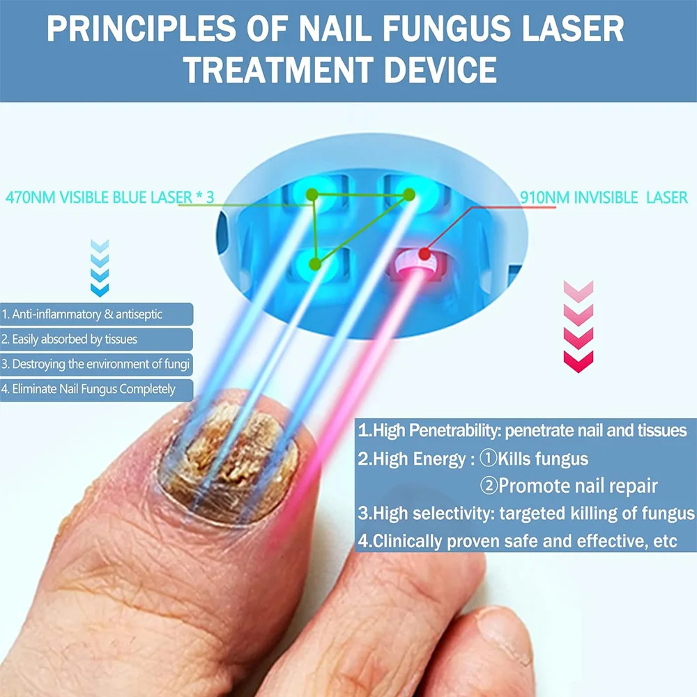 Nail Fungus Treatment LED Laser Device Cleaning Onychomycosis USB Charge 905nm Infrared Light 470nm Blue Light Nail Salon nail fungus treatment
