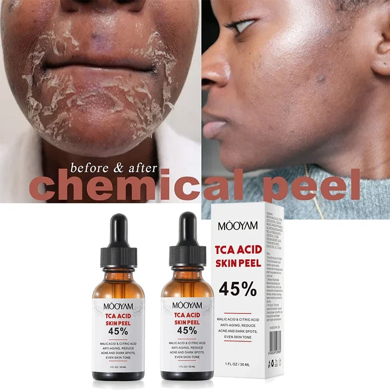 ChemicalPeelTcaPeelAcidPeelingAcid715DaysDeliveredSkinSuperforcePeeling