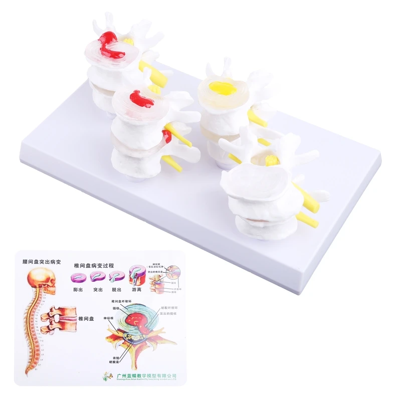 

1 Set Human Lumbar Lesion Spine Statue Display Model Medical Teaching Learning f