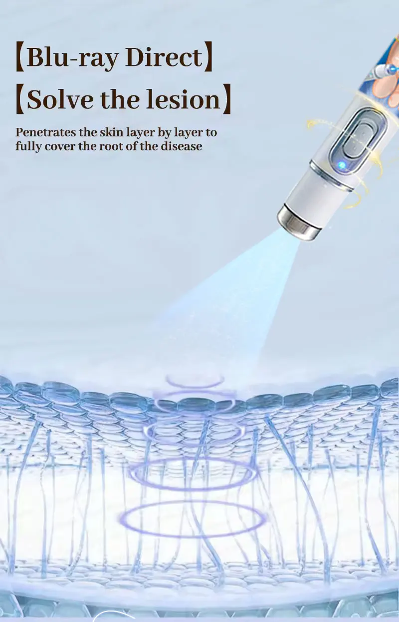 Latest Upgraded Blue Light Pen, Best-selling Wart Care_voghion.com