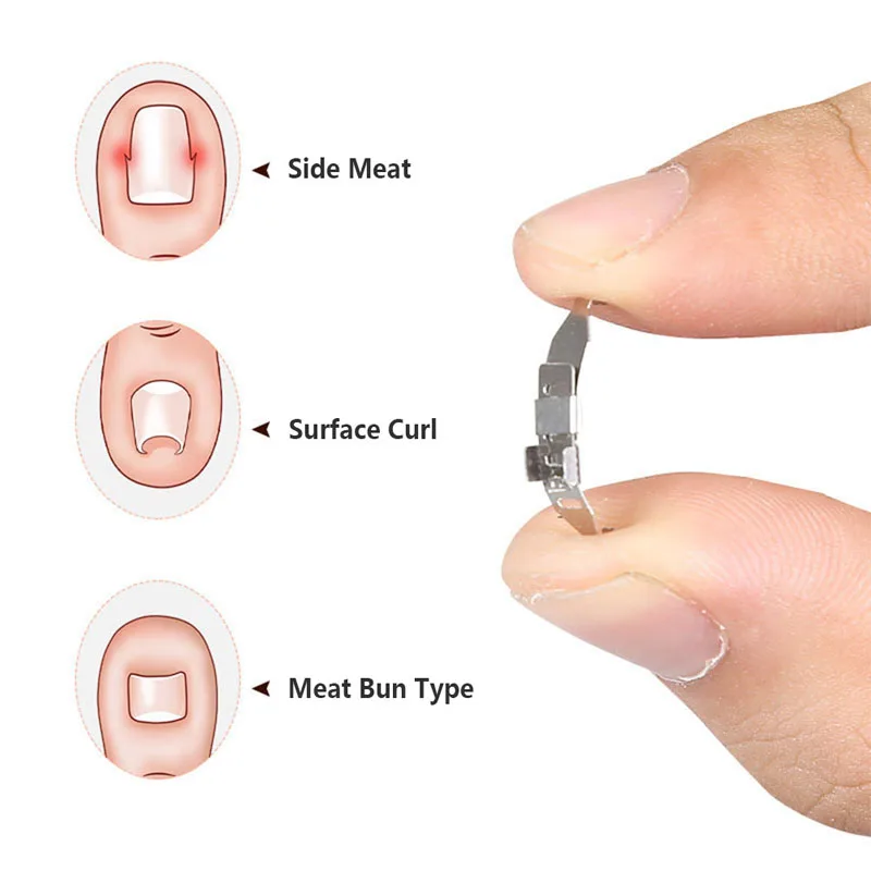 

Ingrown Toenail Corrector Correction Buckle Pedicure Carbon Steel Foot Care