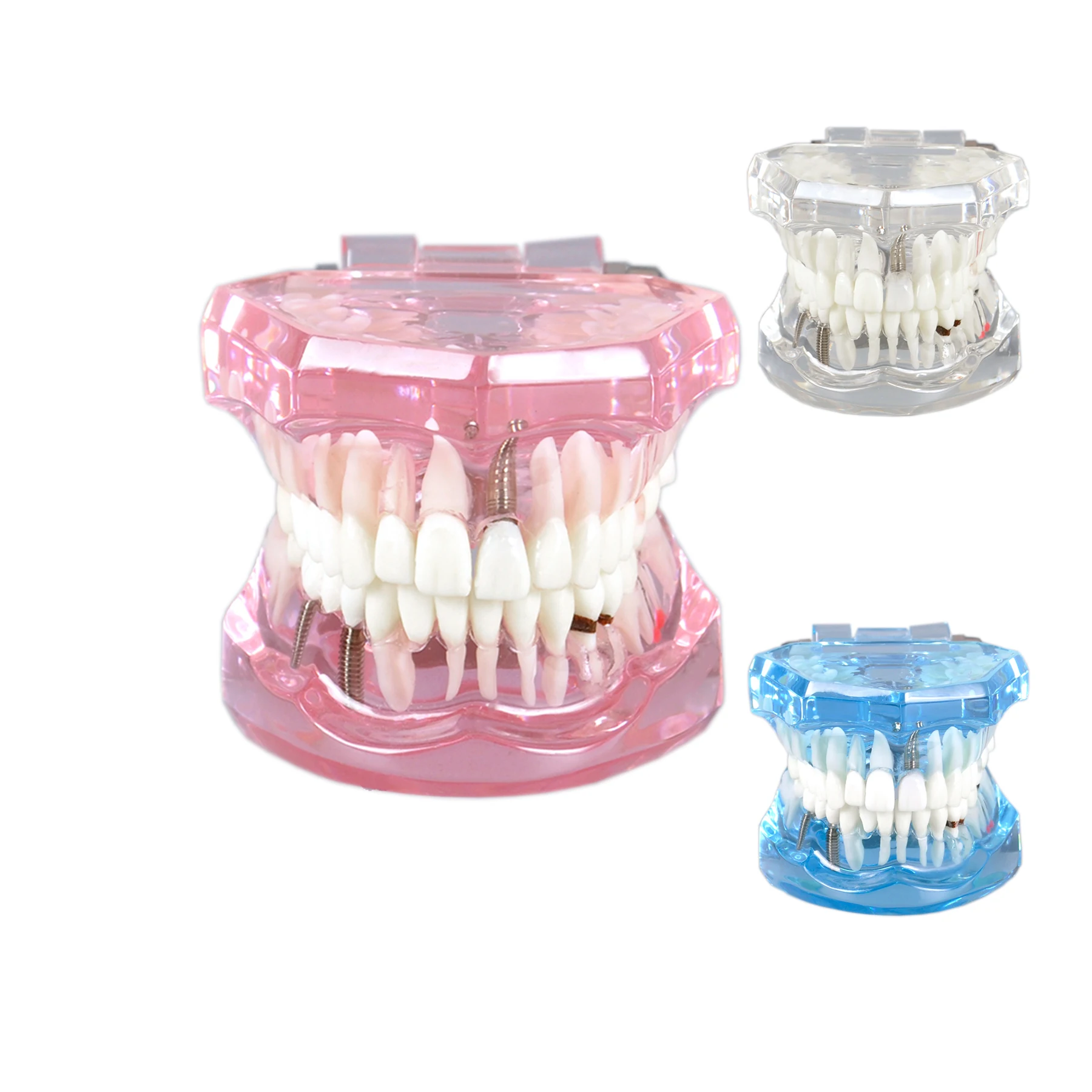 

Transparent Tooth Model Dental Disease Implant Teeth Model Removable, Dentist Standard Tooth Pathological Demonstration - Teach