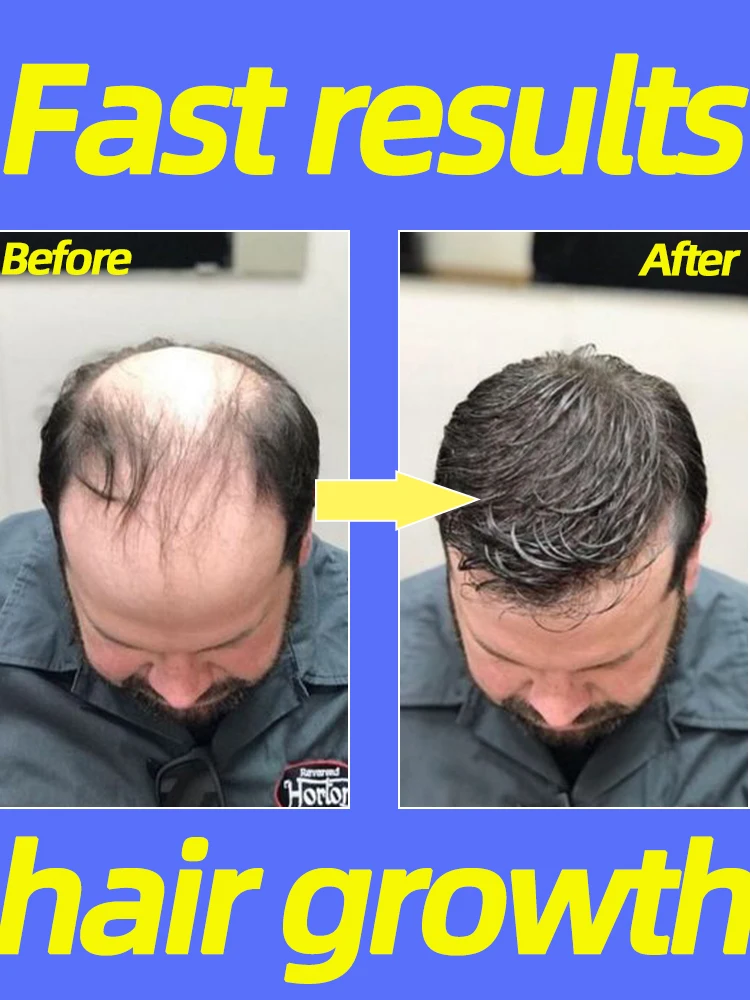 

Hair Growth Regrowth Oil Anti Loss