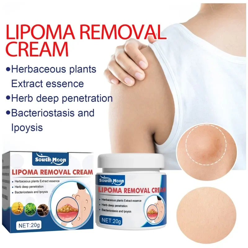 Lipoma Removal Ointment Cellulite Treatment Fibroma Remover Subcutaneous Lumps Multiple Lipomas Fat Mass Medicines Cream 20G cream lumps remover