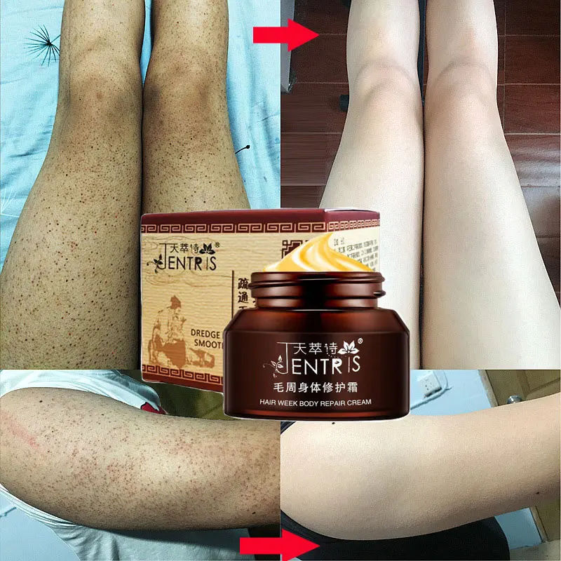 50g Curing Keratosis Pilaris Chicken Follicle Skin Repair Cream Body