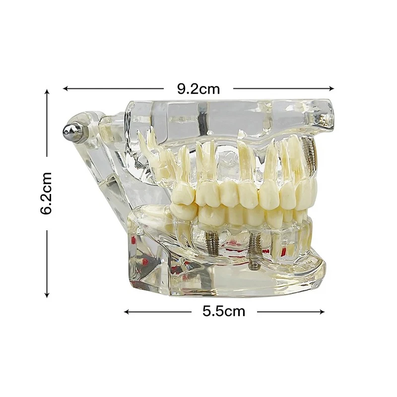 VVDental 치과 질환 치아 모형 치과 질환 교육용 연구 모형 의학용 수복 브릿지 치아 포함