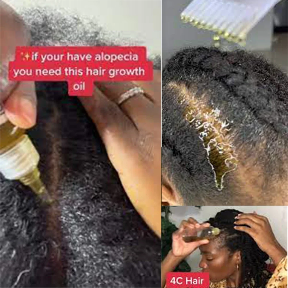 GROW Back Your EDGES FASTER Regrow Your Edges Bald Spots and Thinning Hair in 4 Weeks No More Traction Hair Loss