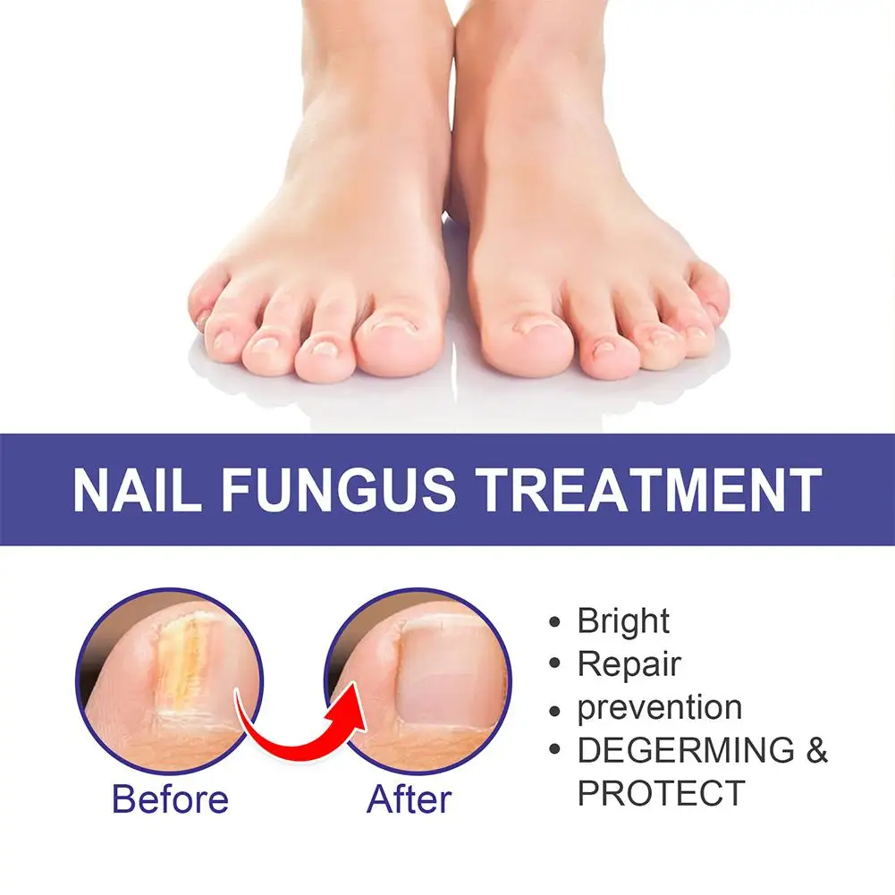 5PCS Nail Fungal Treatment Feet Care Essence Anti Infection Paronychia Onychomycosis Nail Repair Toe Fungus Serum Fungal Removal