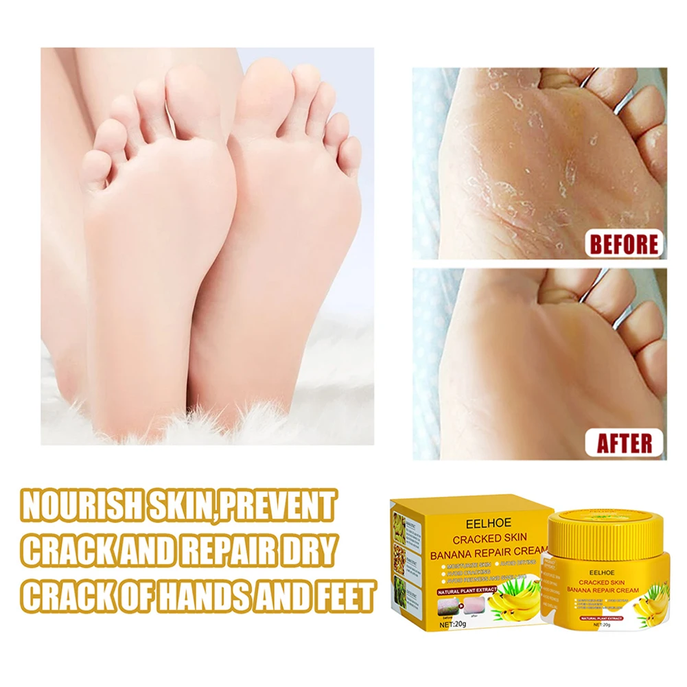 Say goodbye to cracked heels with these easy home remedies