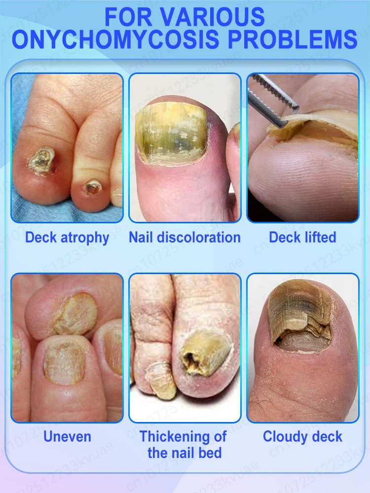 Technology changes pain effectively treats onychomycosis and nail fungus refuses drug treatment