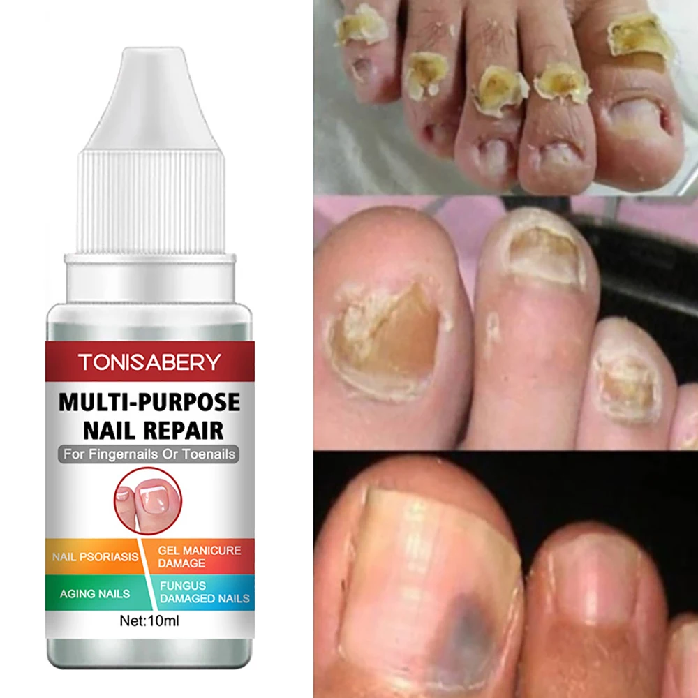 Nail Fungal Treatment Serum Hand Foot Care Removal Gray Nail Repair