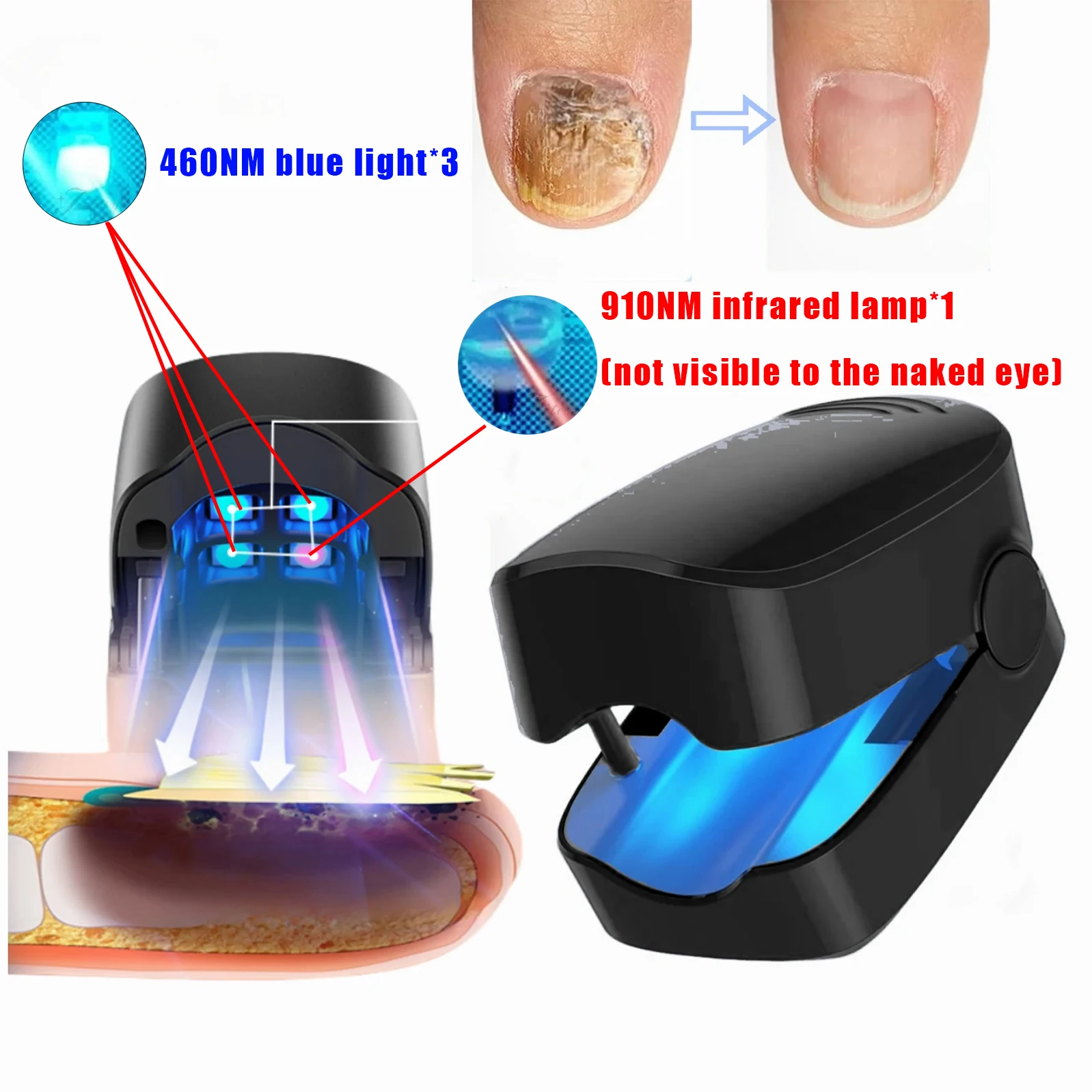 Nail Fungus Remover LED Laser Device for Cleaning Onychomycosis USB Charge 905nm Infrared Light 470nm Blue Light Nail Salon
