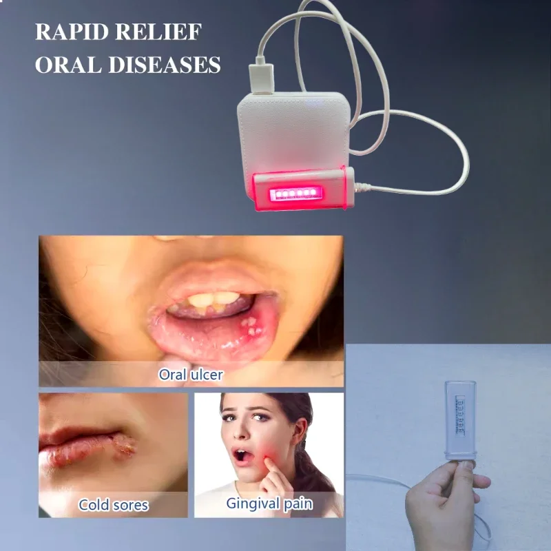 Red Light Therapy for Gum Sensitivity Professional Device for Inflammation Relief & Oral Health Improvement